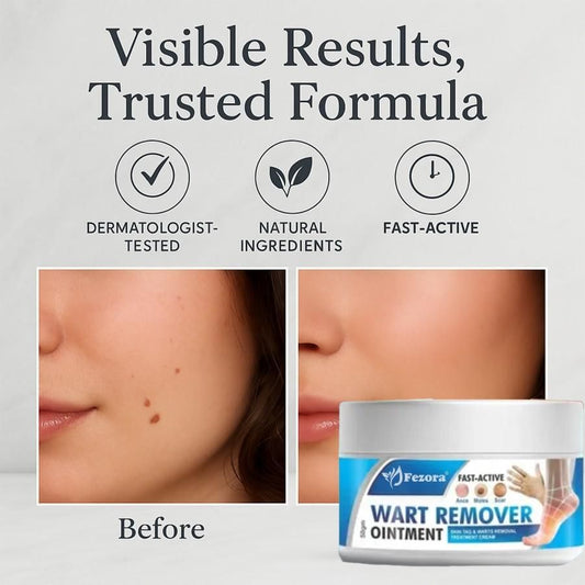 Wart remover cream for wart removal (50gm)